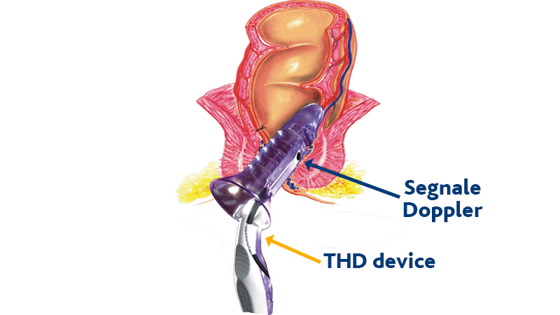 THD Doppler