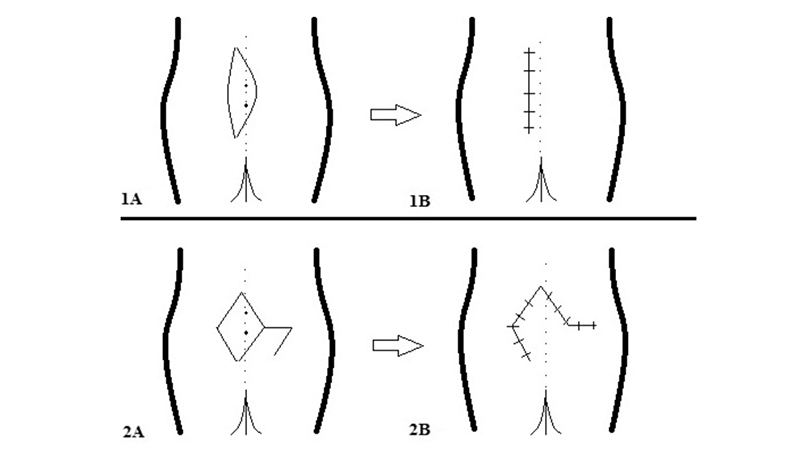 Karydakis (1A, 1B) e Limberg Flap (2A, 2B)